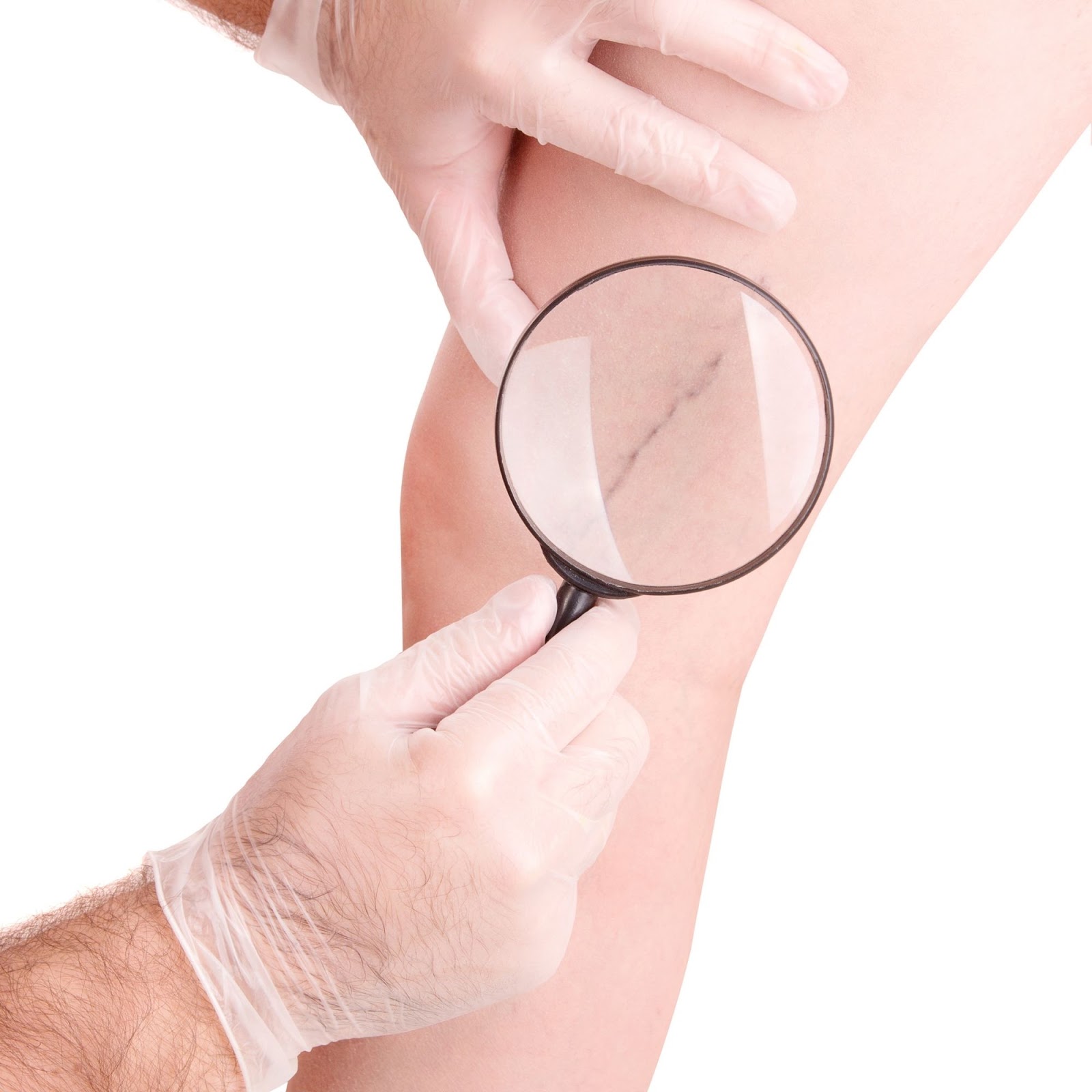 varicose veins