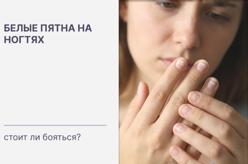Стоит ли бояться белых пятен на ногтях?